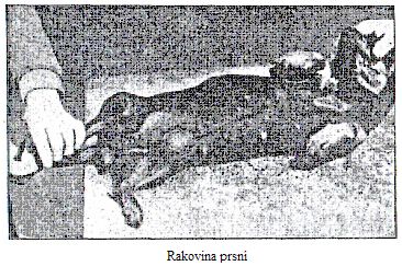 Rakovina prsn